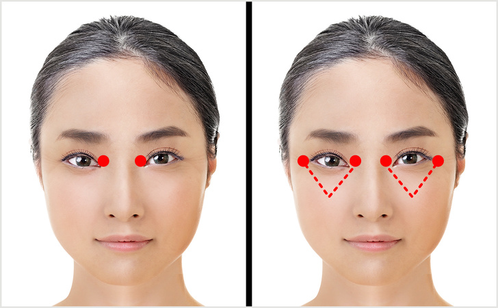 Technique for rejuvenation of the area around the eyes